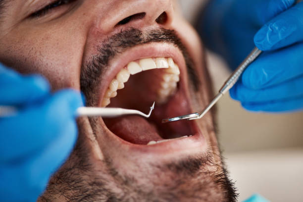 Best Emergency Dental Care for Broken or Chipped Teeth in Cherry Valley, CA